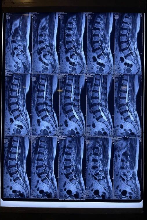 What is the most common spine surgery