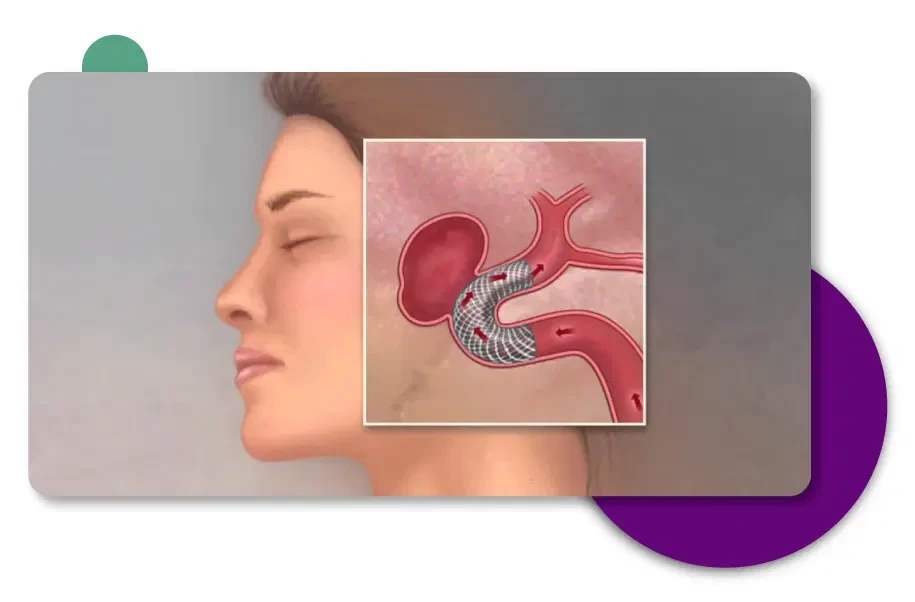 Brain aneurysm treatment by neurosurgeon Dr. Vikas Kathuria in Gurgaon for gym-goers with heavy lifting headache