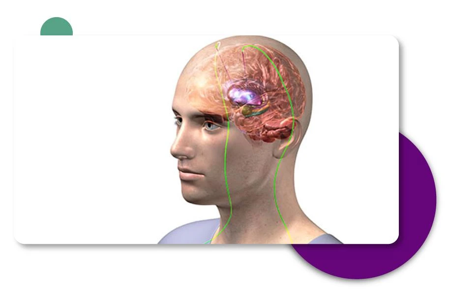 Neurosurgeon Dr. Vikas Kathuria explaining brain treatment for Parkinson's disease in Gurgaon